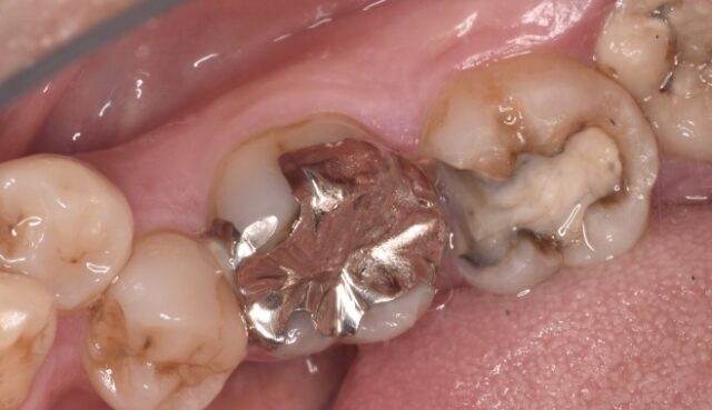 銀歯が外れた状態の口腔内